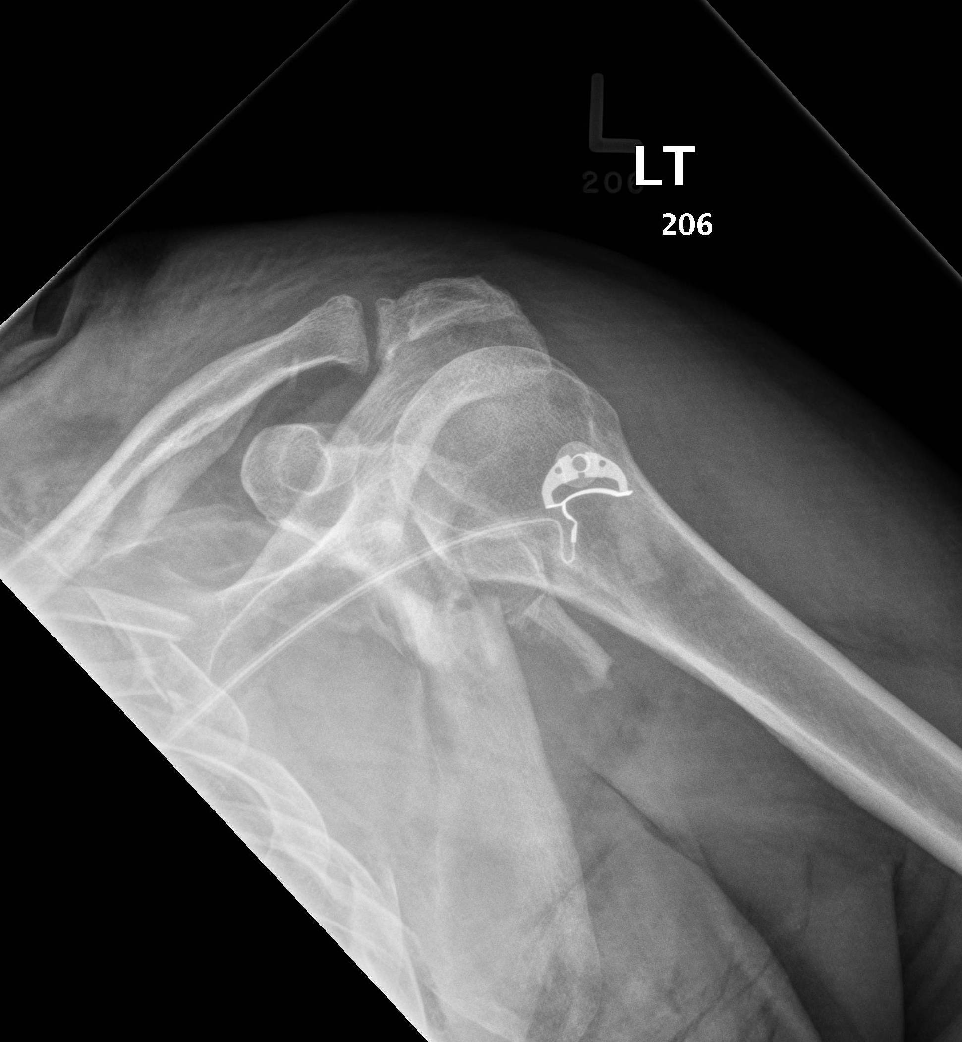 Glenoid & Scapula Fractures The Bone School
